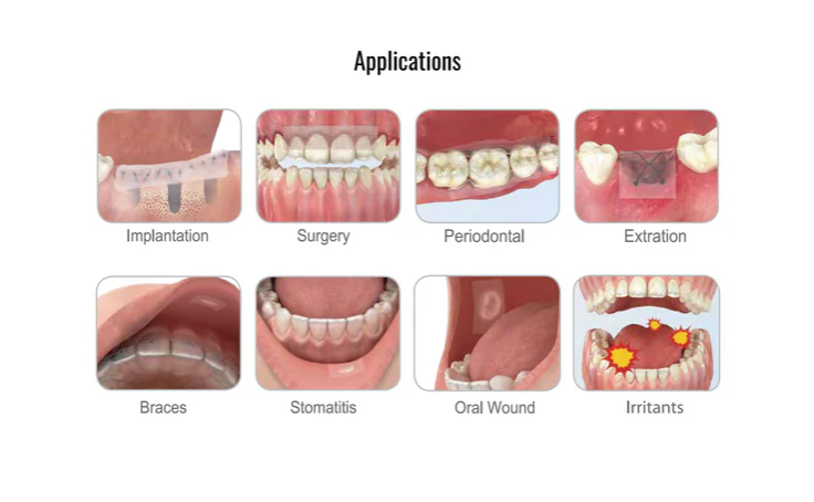 Ora-Aid – intraoral wound dressing