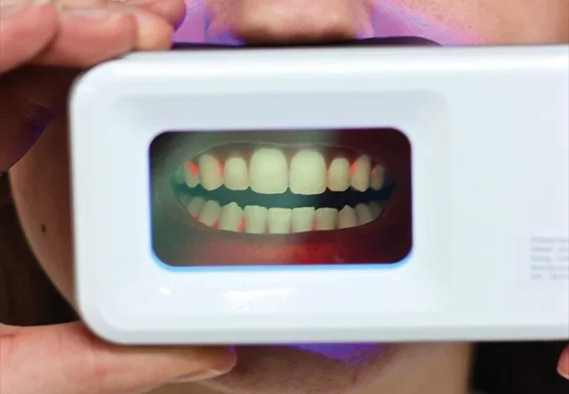 QScan Plus-UV plaque detector