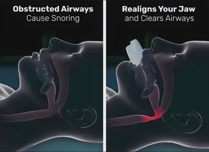 hushd™ Avera Anti-Snoring Mouthpiece | Custom-Fit Sleep Appliance